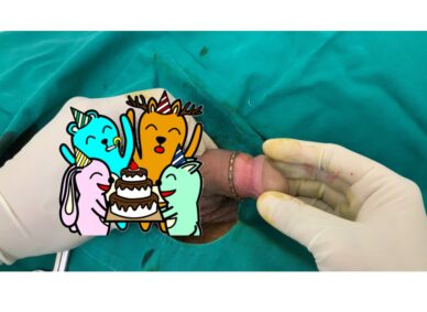 Cắt bao quy đầu ở Hưng Yên