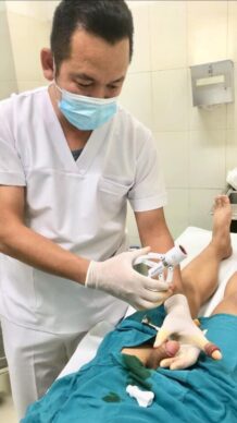 Cắt bao quy đầu ở Hưng Yên